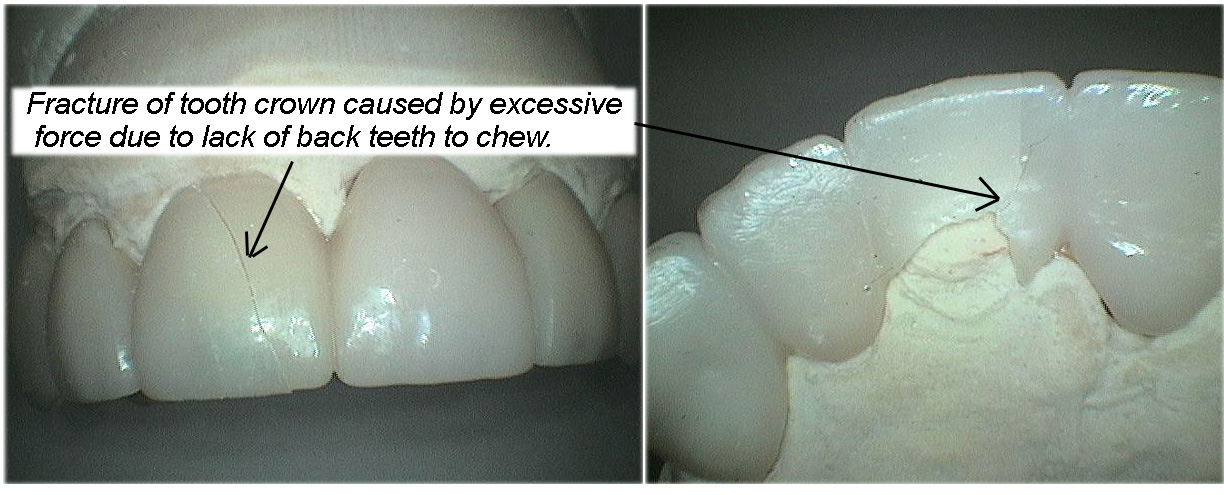 The Need for our back teeth
