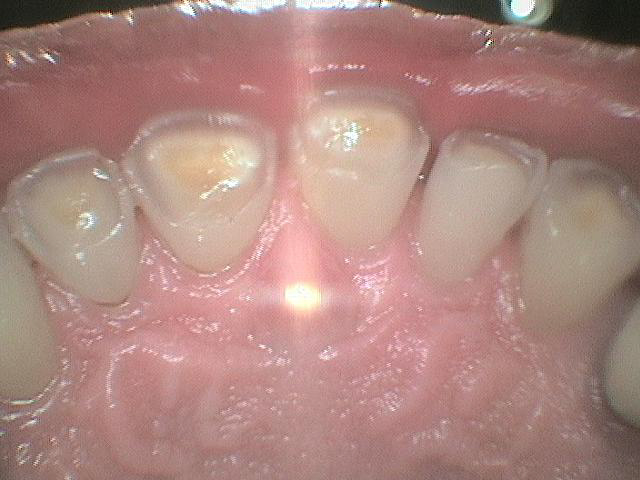 Vertical (Occlusal) Tooth wear
