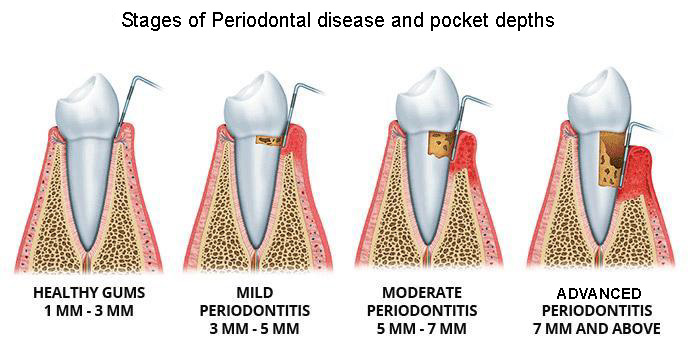 Types of periodontal disease